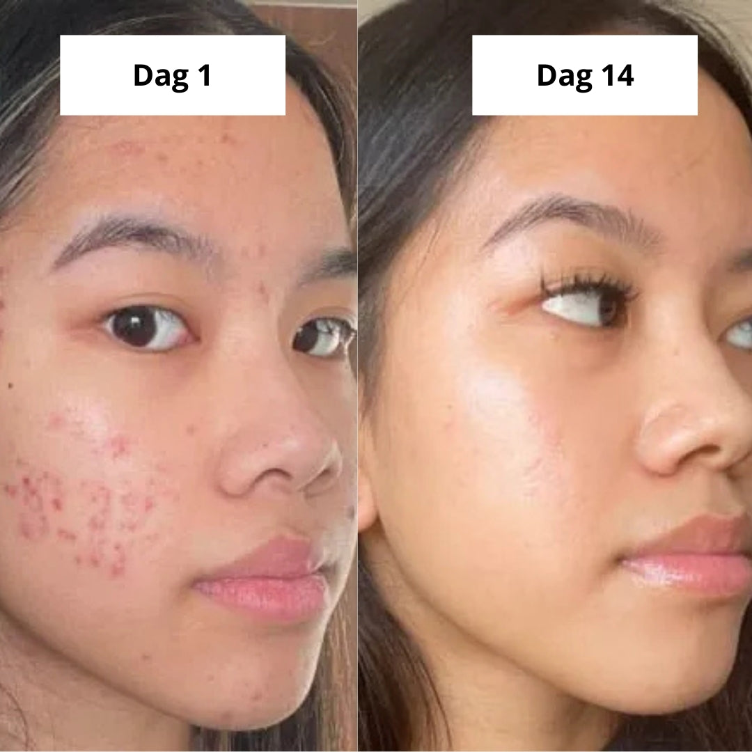 Biologische Kurkuma zeep | Vermindert zichtbaar pigmentvlekken & acne