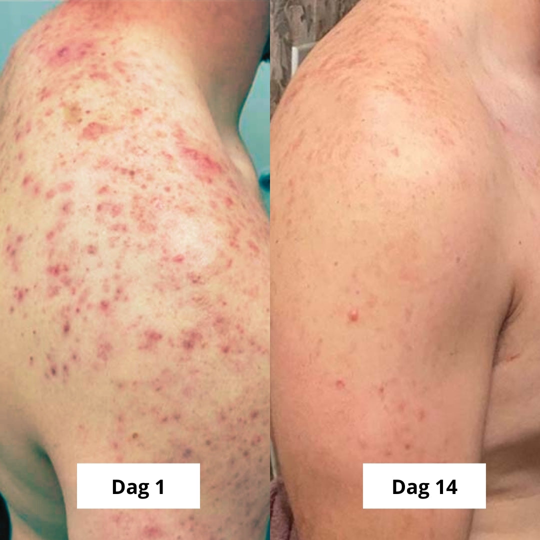Biologische Kurkuma zeep | Vermindert zichtbaar pigmentvlekken & acne