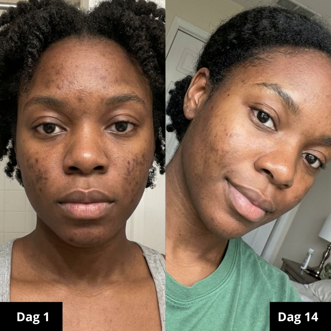 Biologische Kurkuma zeep | Vermindert zichtbaar pigmentvlekken & acne