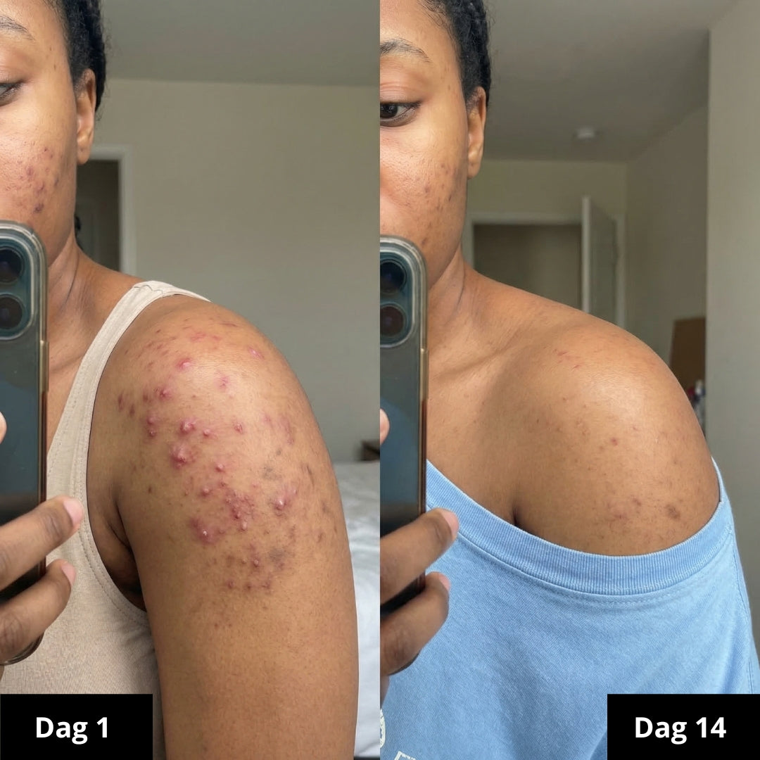 Biologische Kurkuma zeep | Vermindert zichtbaar pigmentvlekken & acne