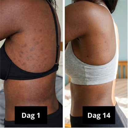 Biologische Kurkuma zeep | Vermindert zichtbaar pigmentvlekken & acne